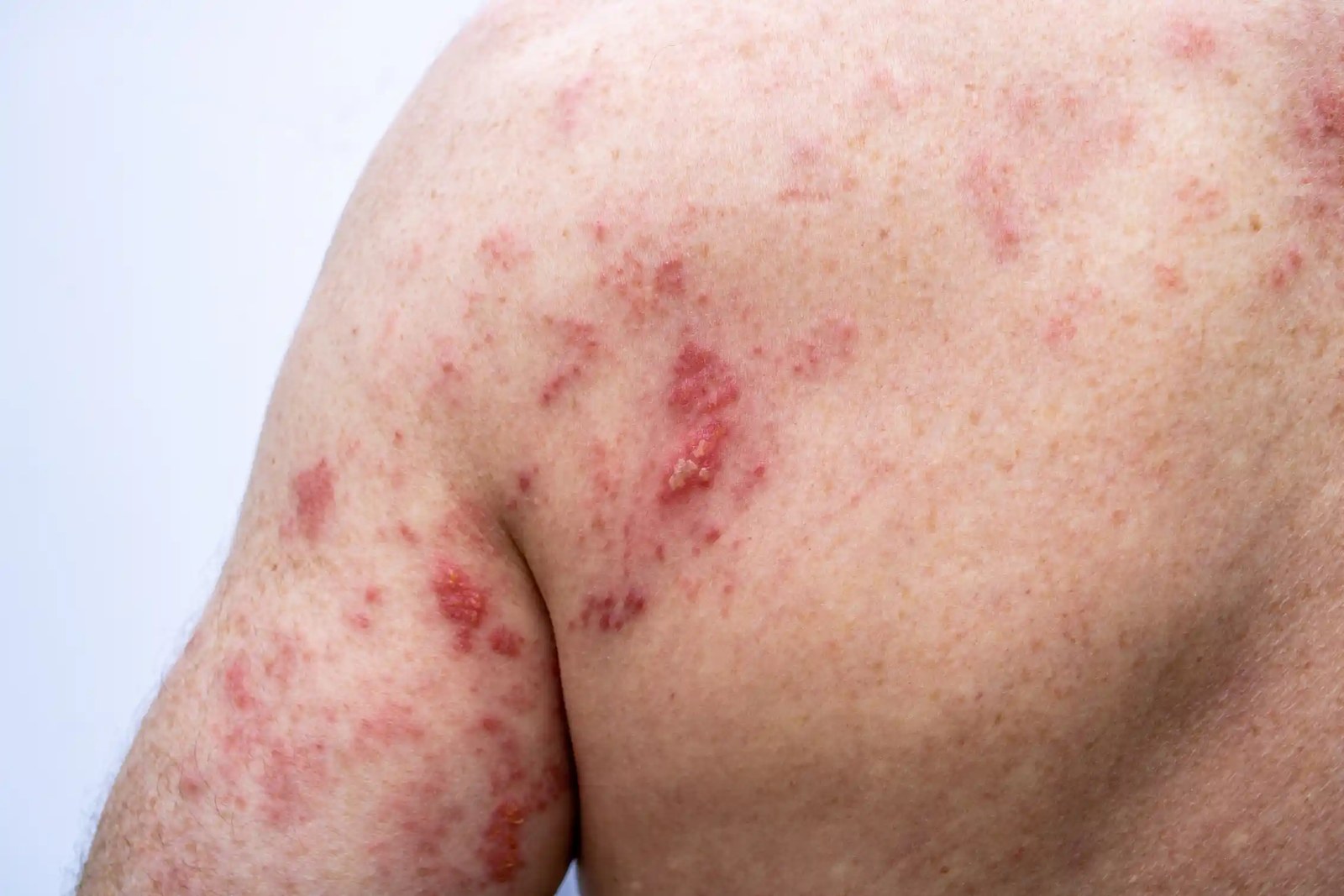 Close-up of red rash across a person's upper back and arm