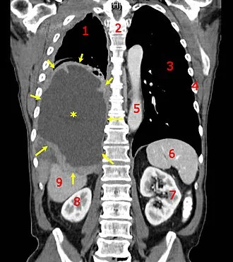 Tumor Mesothelioma2 legend